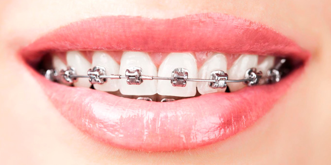 Sonrisa con ortodoncia 